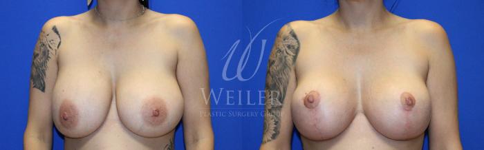 Before & After Breast Lift with Augmentation Case 1131 Front View in Baton Rouge, New Orleans, & Lafayette, Louisiana