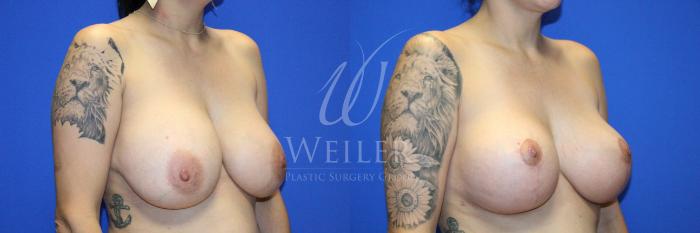 Before & After Breast Lift with Augmentation Case 1131 Left Oblique View in Baton Rouge, New Orleans, & Lafayette, Louisiana