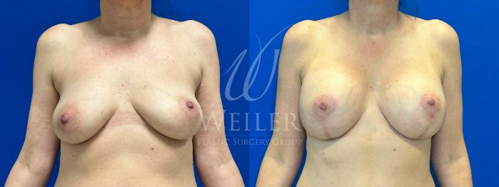 Before & After Breast Lift with Augmentation Case 1185 Front View in Baton Rouge, New Orleans, & Lafayette, Louisiana