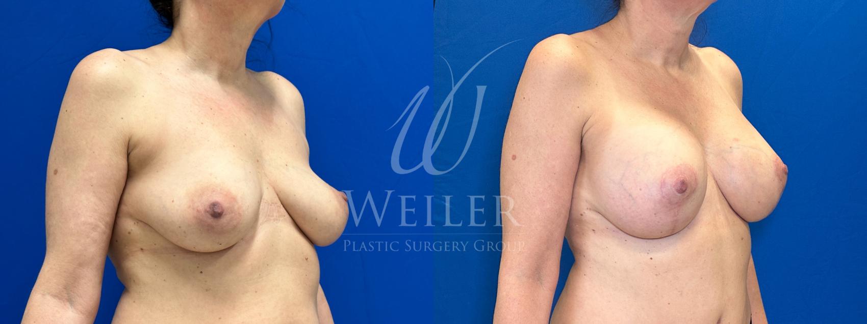 Breast Lift With Augmentation Before And After Pictures Case 1185 Baton Rouge New Orleans