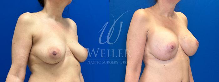 Before & After Breast Lift with Augmentation Case 1185 Right Oblique View in Baton Rouge, New Orleans, & Lafayette, Louisiana