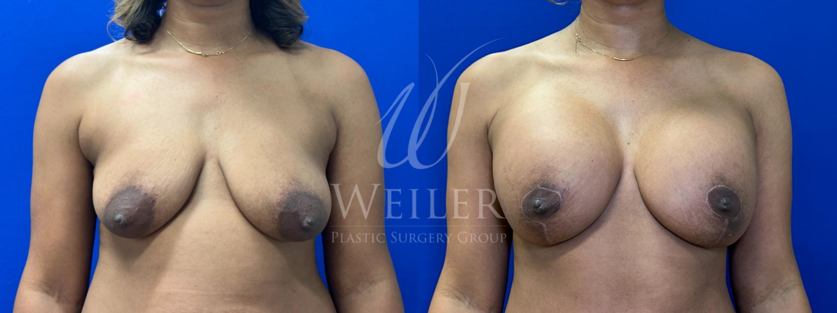 Before & After Breast Lift with Augmentation Case 1187 Front View in Baton Rouge, New Orleans, & Lafayette, Louisiana
