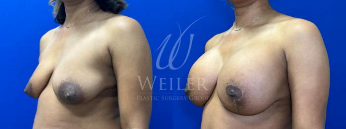 Before & After Breast Lift with Augmentation Case 1187 Left Oblique View in Baton Rouge, New Orleans, & Lafayette, Louisiana