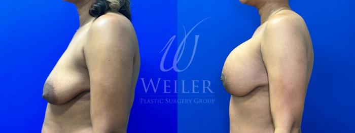 Before & After Breast Lift with Augmentation Case 1187 Left Side View in Baton Rouge, New Orleans, & Lafayette, Louisiana