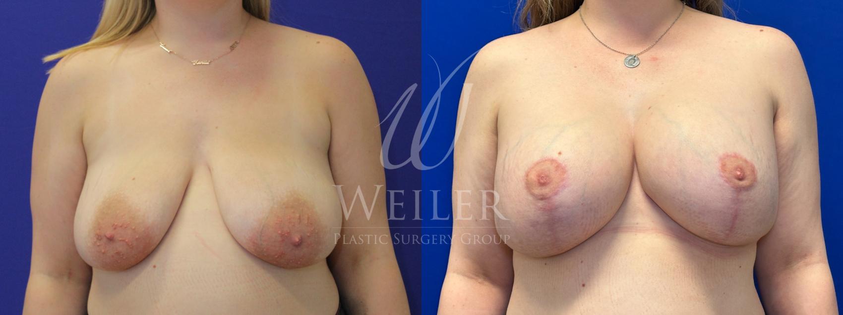 Before & After Breast Lift with Augmentation Case 1188 Front View in Baton Rouge, New Orleans, & Lafayette, Louisiana
