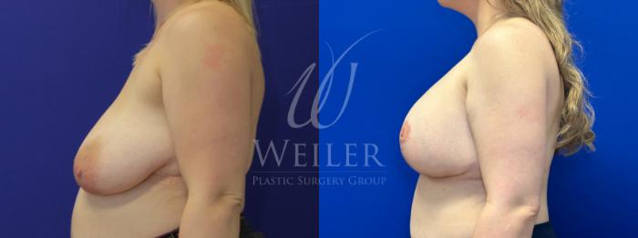Before & After Breast Lift with Augmentation Case 1188 Left Side View in Baton Rouge, New Orleans, & Lafayette, Louisiana