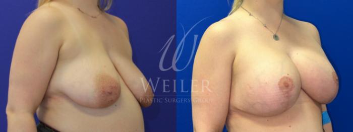 Before & After Breast Lift with Augmentation Case 1188 Right Oblique View in Baton Rouge, New Orleans, & Lafayette, Louisiana