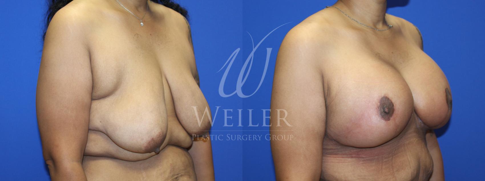 Before & After Breast Lift with Augmentation Case 1221 Right Oblique View in Baton Rouge, New Orleans, & Lafayette, Louisiana
