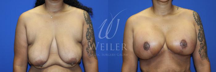 Before & After Breast Lift with Augmentation Case 1230 Front View in Baton Rouge, New Orleans, & Lafayette, Louisiana