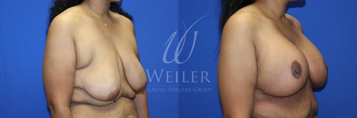 Before & After Breast Lift with Augmentation Case 1230 Left Oblique View in Baton Rouge, New Orleans, & Lafayette, Louisiana