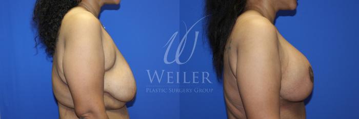 Before & After Breast Lift with Augmentation Case 1230 Left Side View in Baton Rouge, New Orleans, & Lafayette, Louisiana