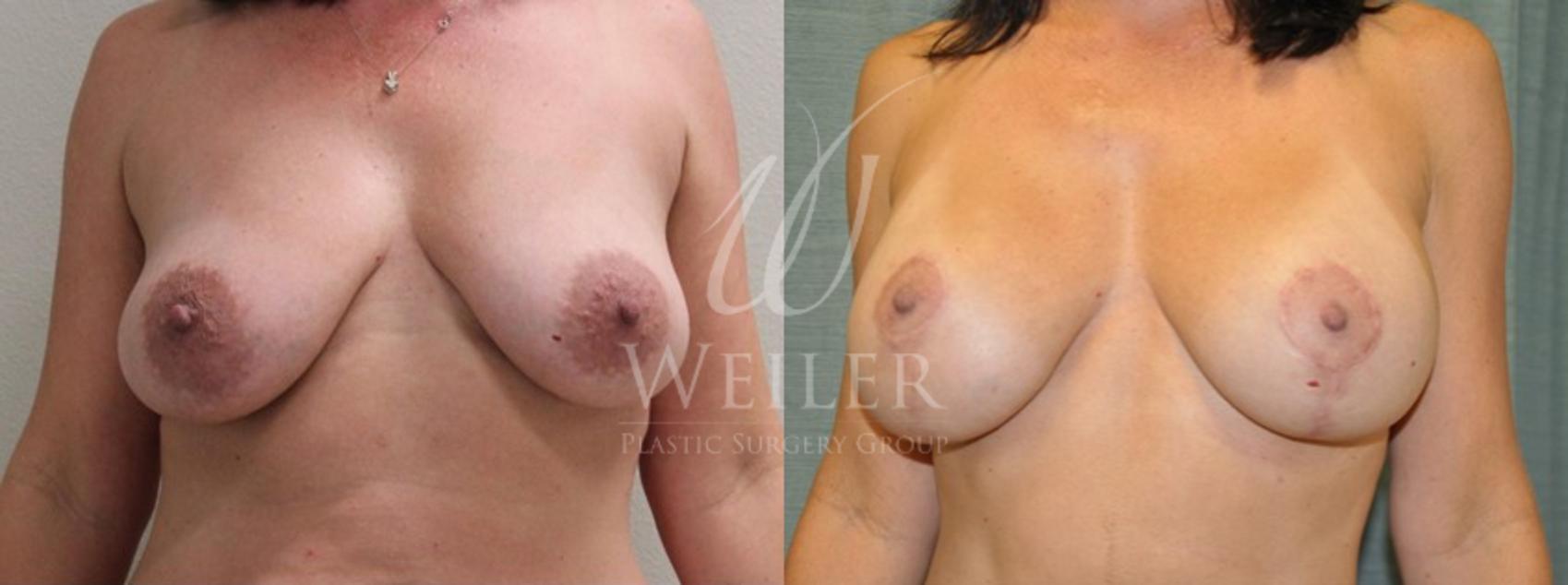 Before & After Breast Lift with Augmentation Case 136 View #1 View in Baton Rouge, New Orleans, & Lafayette, Louisiana