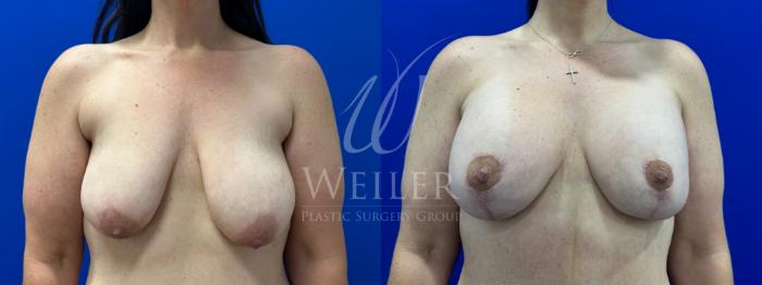 Before & After Breast Lift with Augmentation Case 1379 Front View in Baton Rouge, New Orleans, & Lafayette, Louisiana