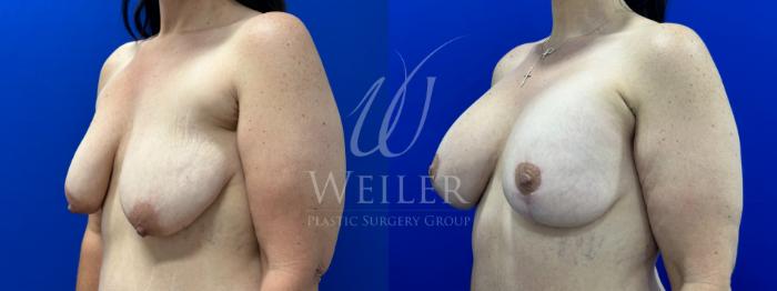 Before & After Breast Lift with Augmentation Case 1379 Left Oblique View in Baton Rouge, New Orleans, & Lafayette, Louisiana