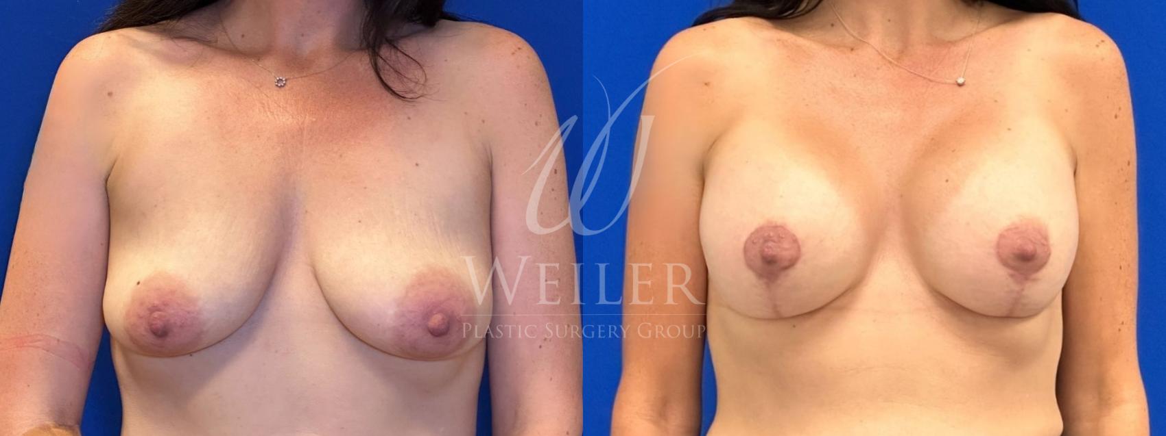 Before & After Breast Lift with Augmentation Case 1391 Front View in Baton Rouge, New Orleans, & Lafayette, Louisiana