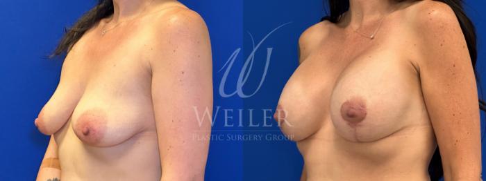 Before & After Breast Lift with Augmentation Case 1391 Left Oblique View in Baton Rouge, New Orleans, & Lafayette, Louisiana