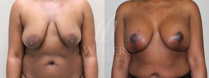 Before & After Breast Lift with Augmentation Case 142 View #1 View in Baton Rouge, New Orleans, & Lafayette, Louisiana