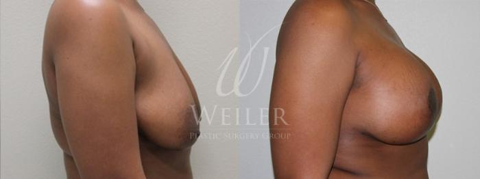 Before & After Breast Lift with Augmentation Case 142 View #2 View in Baton Rouge, New Orleans, & Lafayette, Louisiana