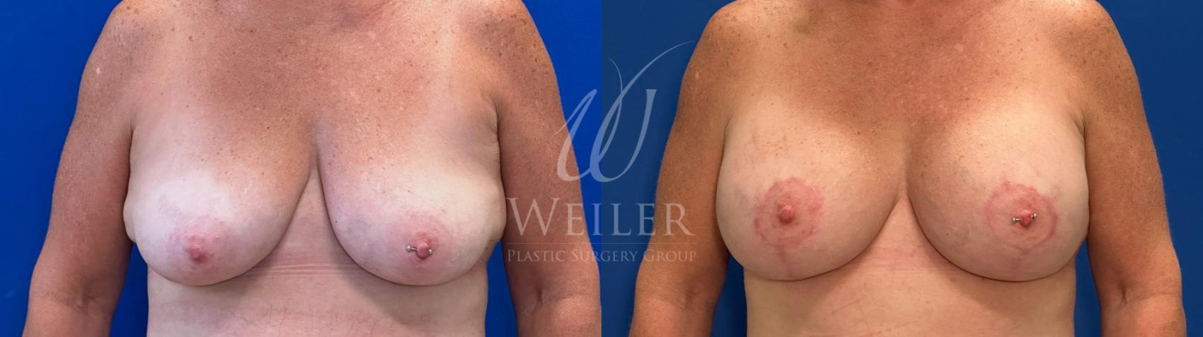 Before & After Breast Lift with Augmentation Case 1494 Front View in Baton Rouge, New Orleans, & Lafayette, Louisiana