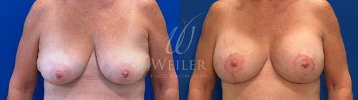 Before & After Breast Lift with Augmentation Case 1494 Front View in Baton Rouge, New Orleans, & Lafayette, Louisiana