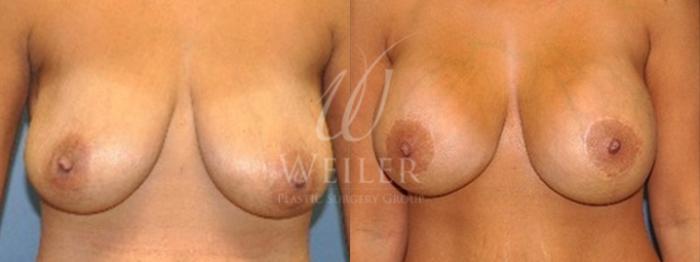 Before & After Breast Lift with Augmentation Case 150 View #1 View in Baton Rouge, New Orleans, & Lafayette, Louisiana