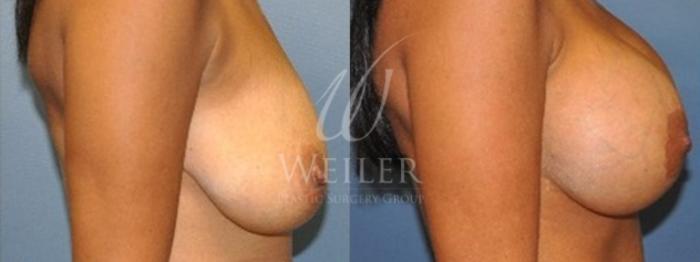 Before & After Breast Lift with Augmentation Case 150 View #2 View in Baton Rouge, New Orleans, & Lafayette, Louisiana