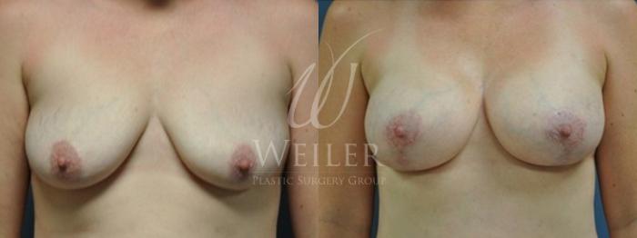 Before & After Breast Lift with Augmentation Case 151 View #1 View in Baton Rouge, New Orleans, & Lafayette, Louisiana