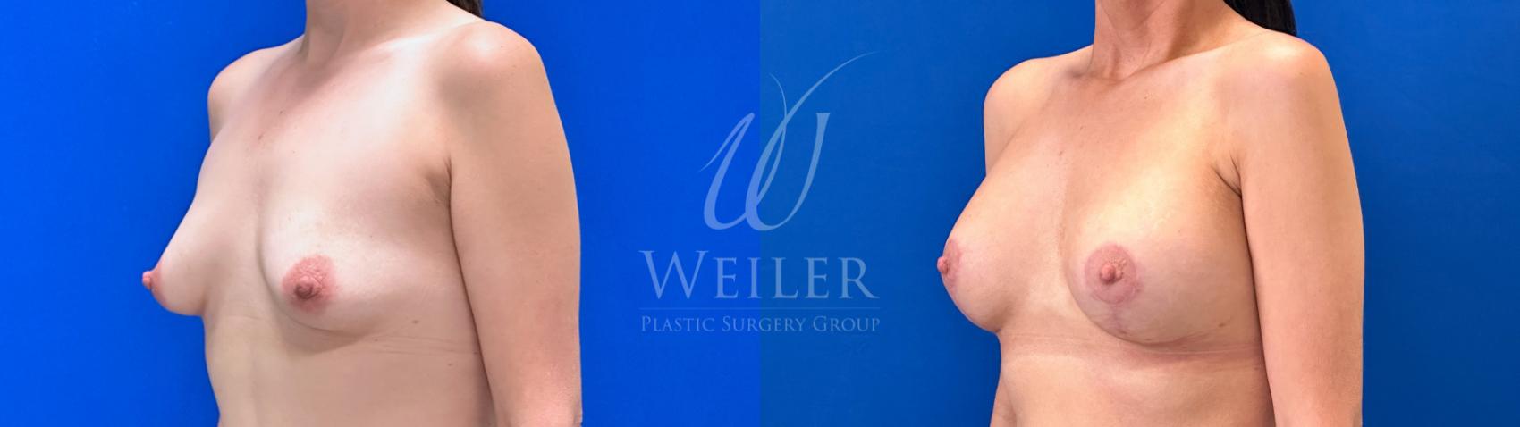 Before & After Breast Lift with Augmentation Case 1513 Left Oblique View in Baton Rouge, New Orleans, & Lafayette, Louisiana