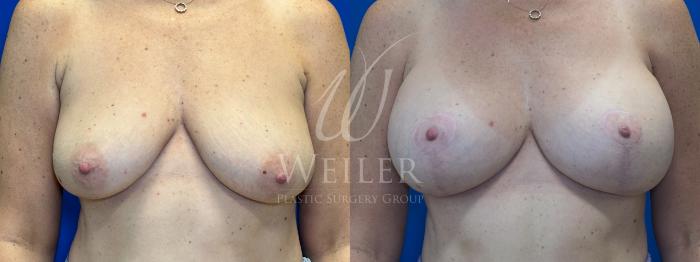 Before & After Breast Lift with Augmentation Case 1515 Front View in Baton Rouge, New Orleans, & Lafayette, Louisiana