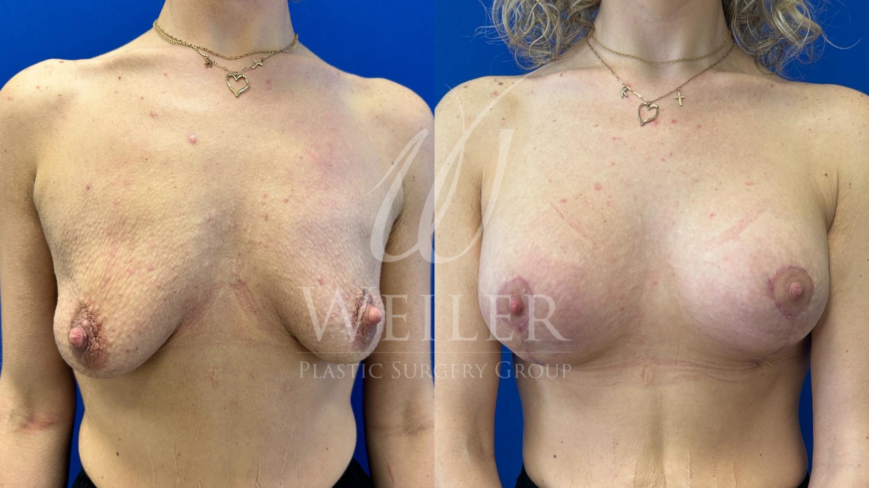 Before & After Breast Lift with Augmentation Case 1516 Front View in Baton Rouge, New Orleans, & Lafayette, Louisiana