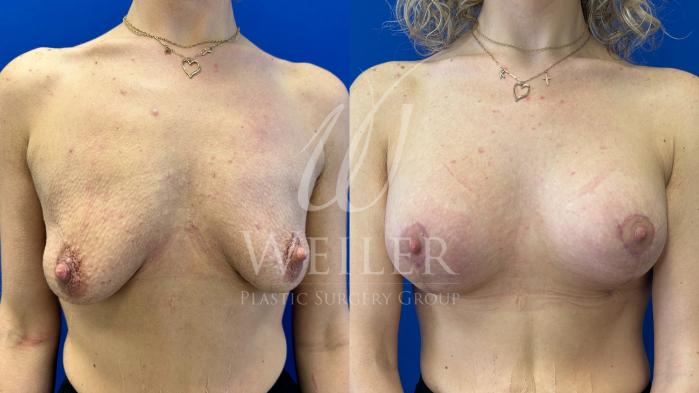 Before & After Breast Lift with Augmentation Case 1516 Front View in Baton Rouge, New Orleans, & Lafayette, Louisiana
