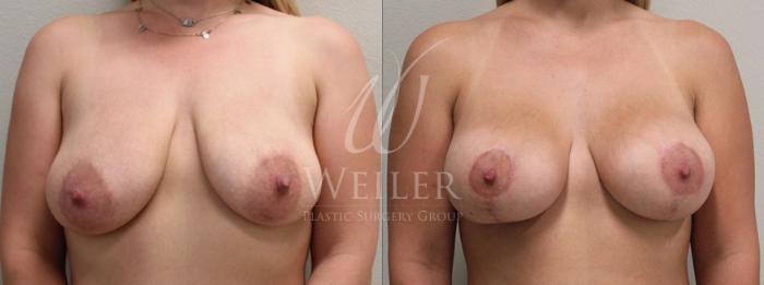 Before & After Breast Lift with Augmentation Case 153 View #1 View in Baton Rouge, New Orleans, & Lafayette, Louisiana
