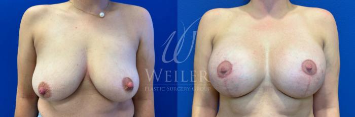 Before & After Breast Lift with Augmentation Case 1571 Front View in Baton Rouge, New Orleans, & Lafayette, Louisiana