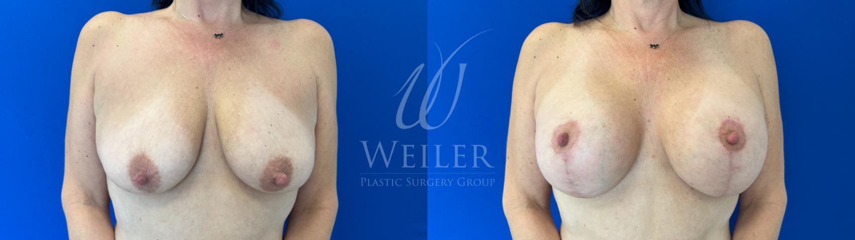 Before & After Breast Lift with Augmentation Case 1600 Front View in Baton Rouge, New Orleans, & Lafayette, Louisiana