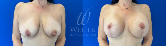 Before & After Breast Lift with Augmentation Case 1600 Front View in Baton Rouge, New Orleans, & Lafayette, Louisiana