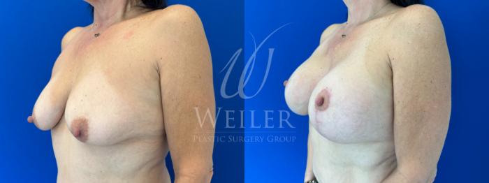 Before & After Breast Lift with Augmentation Case 1600 Left Oblique View in Baton Rouge, New Orleans, & Lafayette, Louisiana