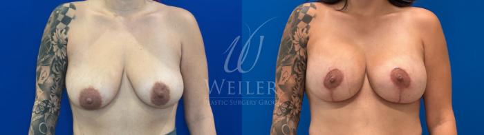 Before & After Breast Lift with Augmentation Case 1620 Front View in Baton Rouge, New Orleans, & Lafayette, Louisiana