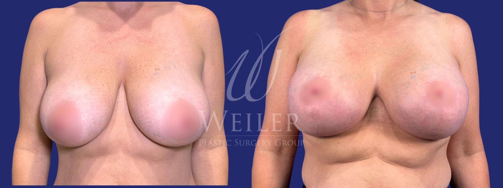 Before & After Breast Lift with Augmentation Case 1631 Front View in Baton Rouge, New Orleans, & Lafayette, Louisiana