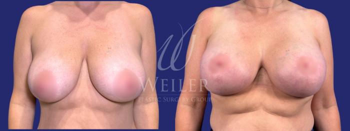 Before & After Breast Lift with Augmentation Case 1631 Front View in Baton Rouge, New Orleans, & Lafayette, Louisiana