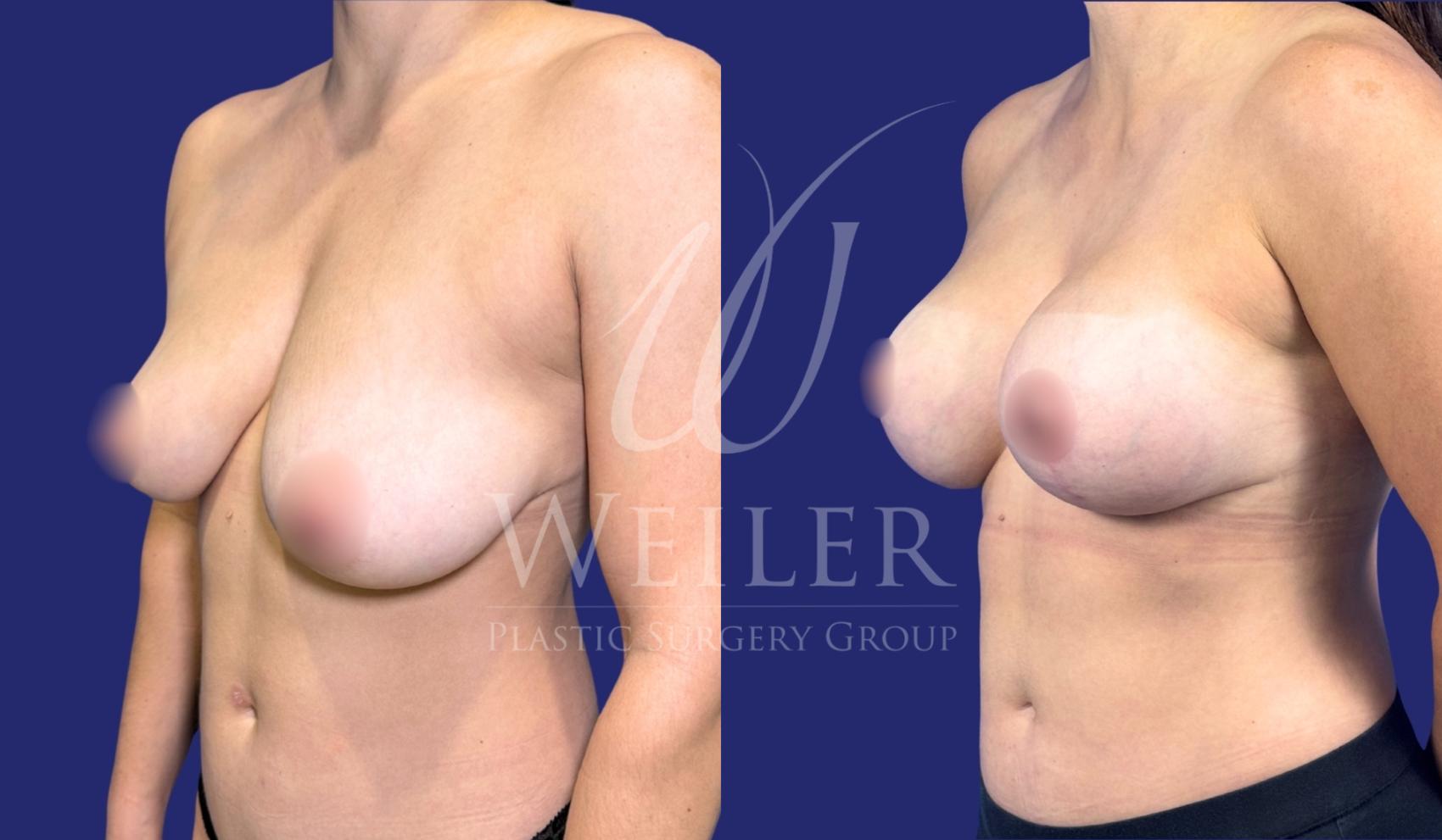 Before & After Breast Lift with Augmentation Case 1639 Left Oblique View in Baton Rouge, New Orleans, & Lafayette, Louisiana