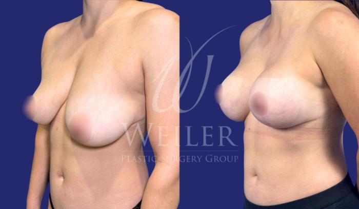 Before & After Breast Lift with Augmentation Case 1639 Left Oblique View in Baton Rouge, New Orleans, & Lafayette, Louisiana