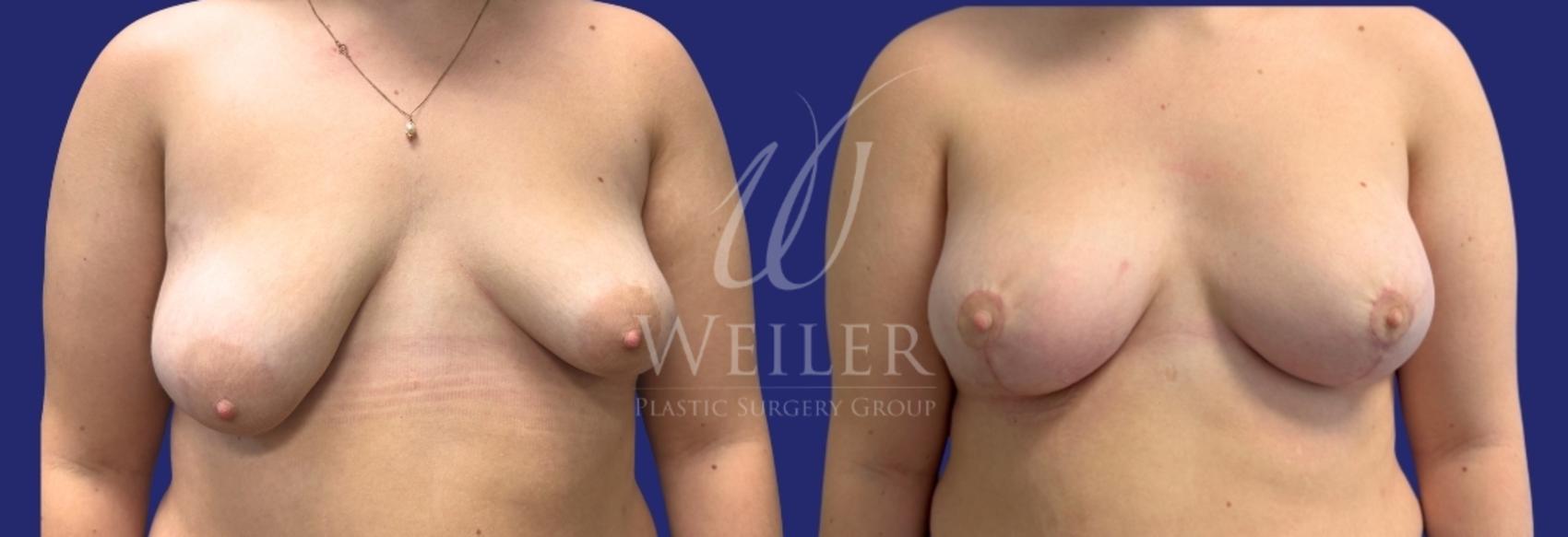 Before & After Breast Lift with Augmentation Case 1688 Front View in Baton Rouge, New Orleans, & Lafayette, Louisiana