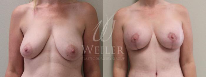 Before & After Breast Lift with Augmentation Case 173 View #1 View in Baton Rouge, New Orleans, & Lafayette, Louisiana