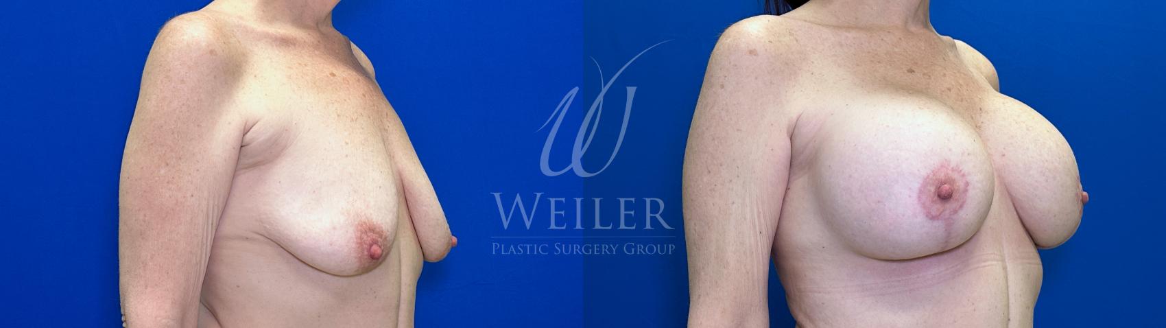 Before & After Breast Lift with Augmentation Case 1735 Right Oblique View in Baton Rouge, New Orleans, & Lafayette, Louisiana
