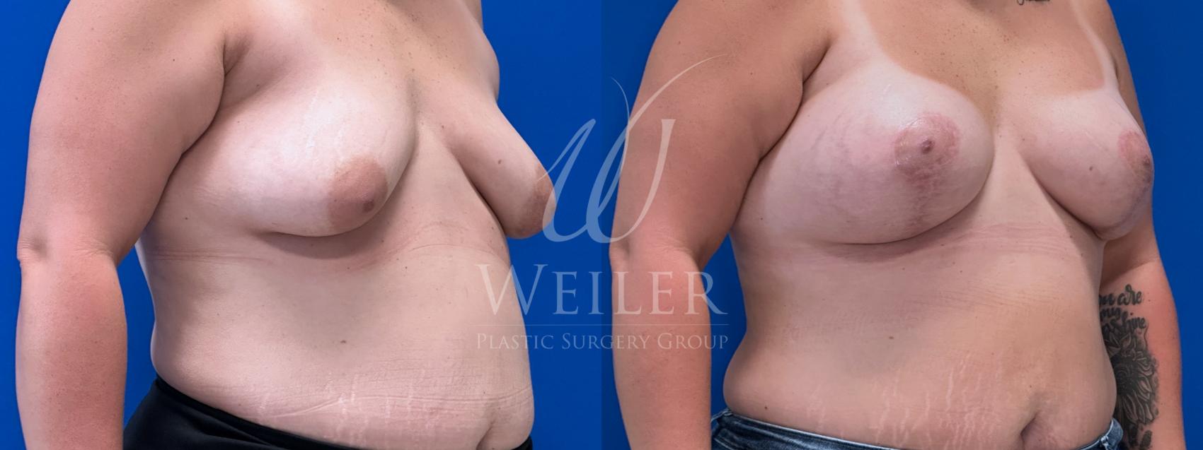 Before & After Breast Lift with Augmentation Case 1758 Right Oblique View in Baton Rouge, New Orleans, & Lafayette, Louisiana