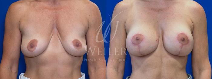Before & After Breast Lift with Augmentation Case 1759 Front View in Baton Rouge, New Orleans, & Lafayette, Louisiana