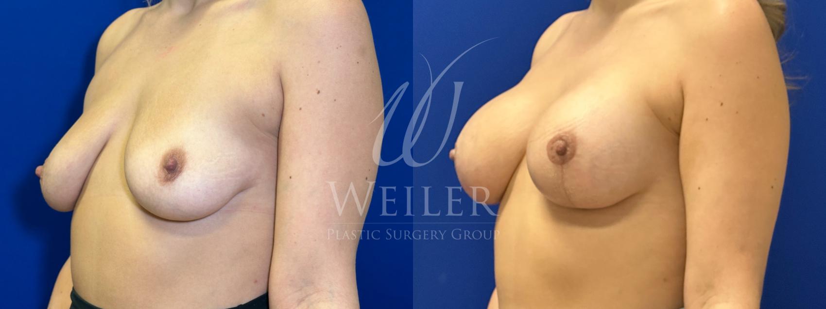 Before & After Breast Lift with Augmentation Case 1760 Left Oblique View in Baton Rouge, New Orleans, & Lafayette, Louisiana