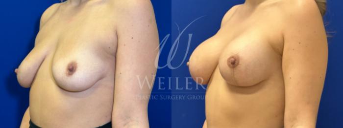 Before & After Breast Lift with Augmentation Case 1760 Left Oblique View in Baton Rouge, New Orleans, & Lafayette, Louisiana