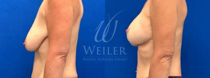 Before & After Breast Lift with Augmentation Case 1761 Left Side View in Baton Rouge, New Orleans, & Lafayette, Louisiana