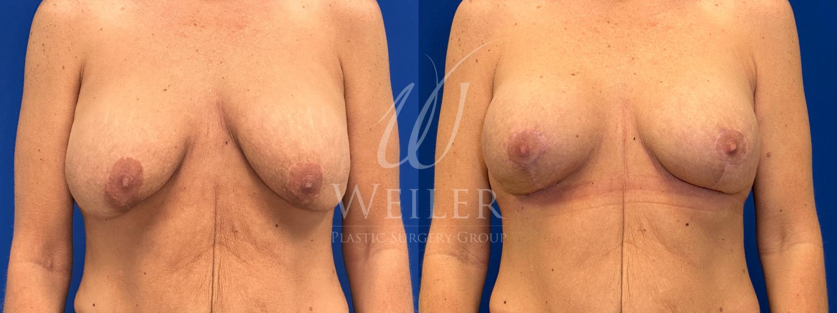 Before & After Breast Lift with Augmentation Case 1763 Front View in Baton Rouge, New Orleans, & Lafayette, Louisiana
